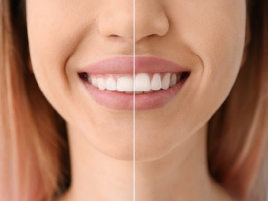 Womans smile before and after gum recontouring