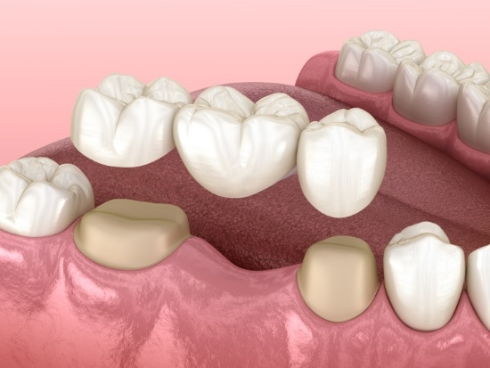 Illustration of dental bridge in El Reno placed on teeth in lower arch