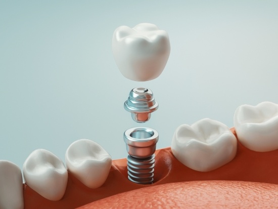 Dental crown, abutment, and dental implant being inserted into jaw