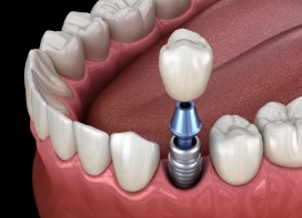 Illustration of crown being attached to dental implant