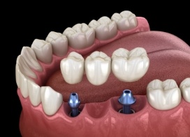 Illustration of dental bridge being attached to two dental implants