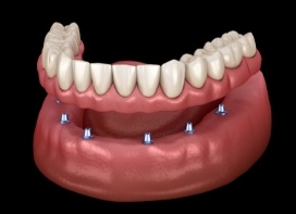 Illustration of denture being attached to six dental implants