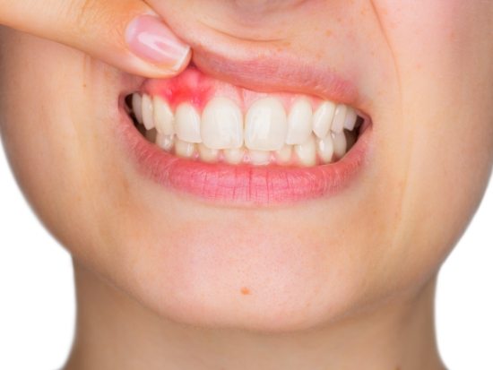 Dental patient pulling up lip showing gum disease