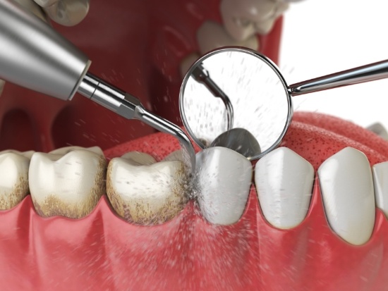 Illustration of scaling and root planing performed on lower teeth