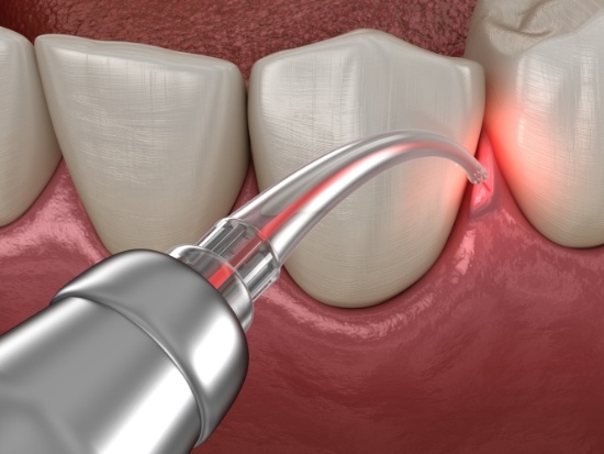 Illustration of a laser treatment for the gums