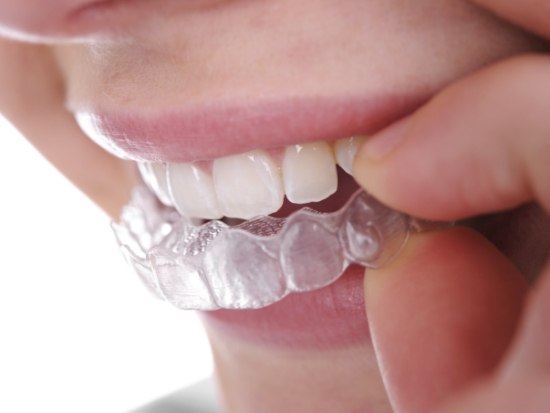 Close up of Invisalign aligner being placed on teeth