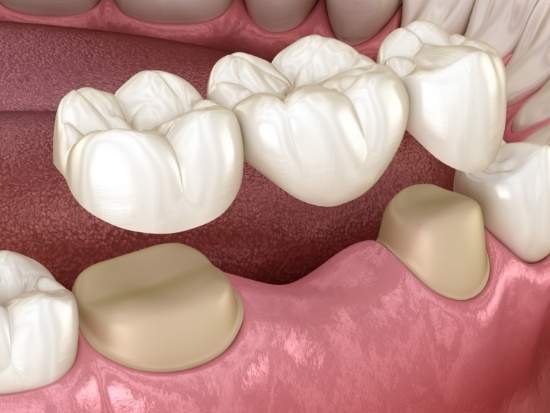 Illustration of dental bridge being placed on teeth