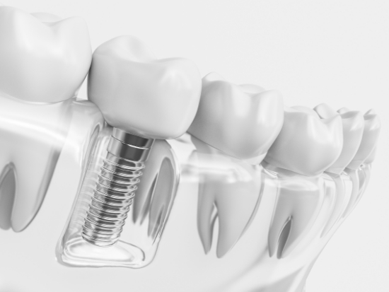 Dental implant in plastic tray