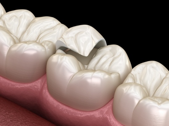 Illustration of onlay being attached to corner of tooth