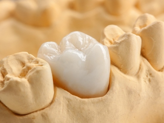 Dental crown in model of the mouth