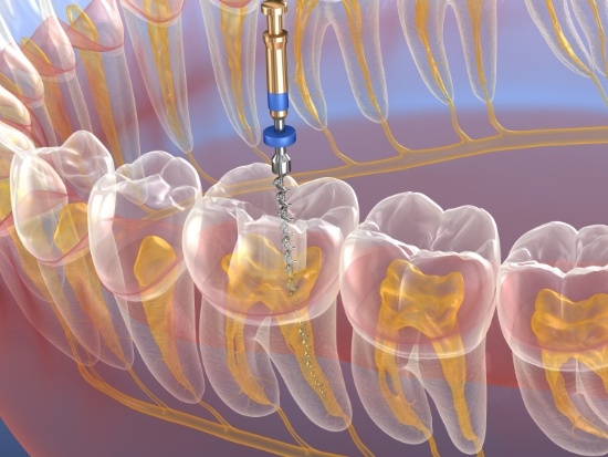 Illustration of a root canal treatment being performed