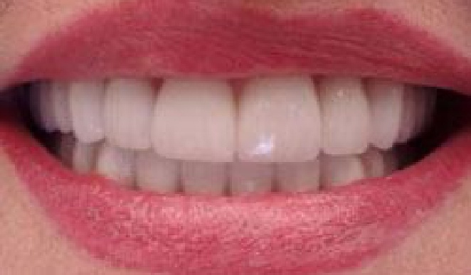 Teeth after dental work