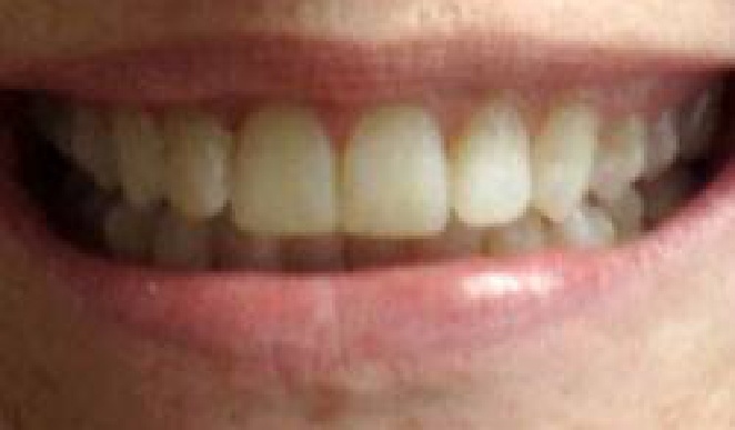 Smile with whitened front teeth