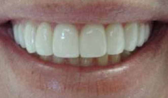 Close up of teeth after treatment