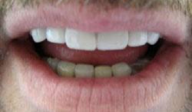 Smile with repaired teeth