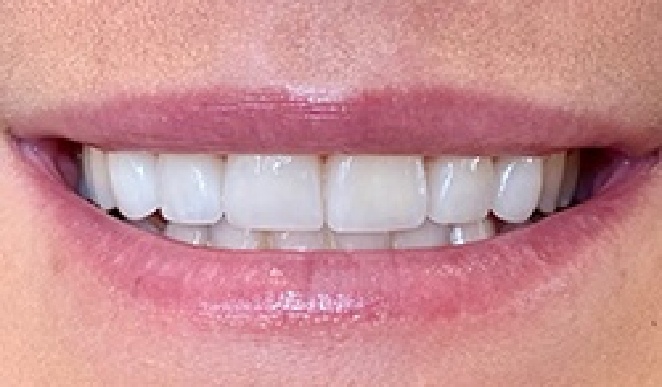 Smile after dental care