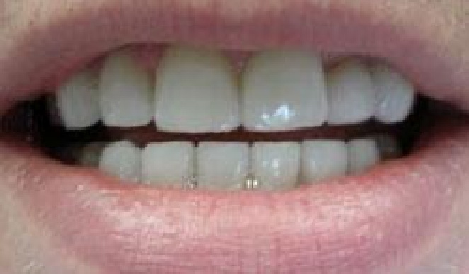 Teeth with blackened spots removed