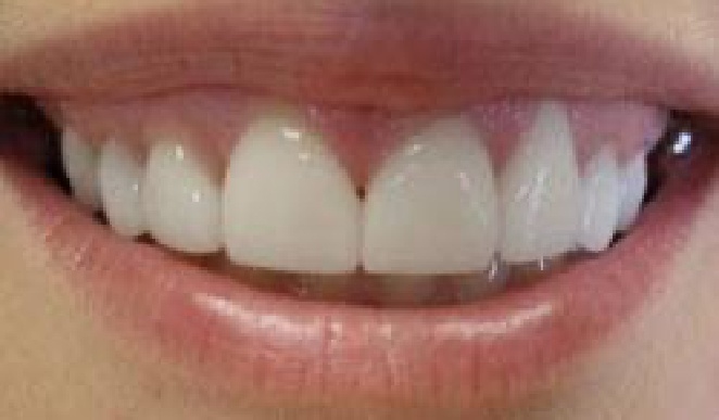 Front teeth properly aligned