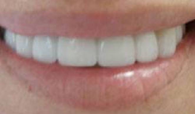 Whiter teeth