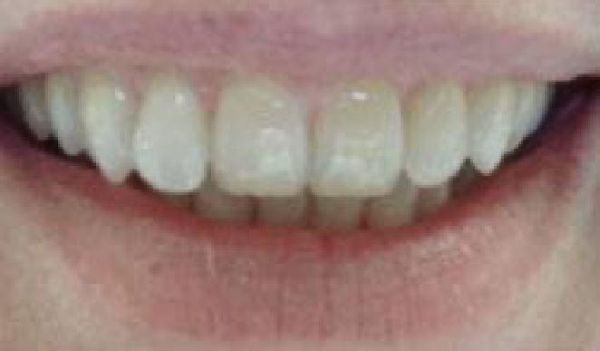 Close up of teeth before treatment