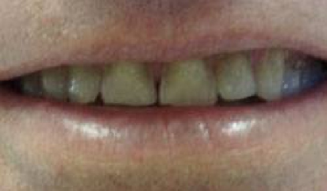 Smile with damaged teeth