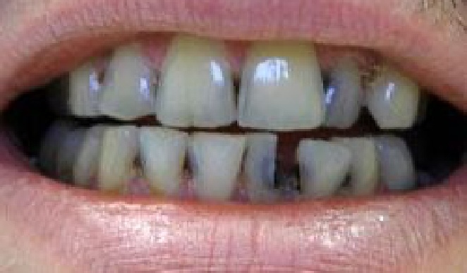 Teeth with blackened spots