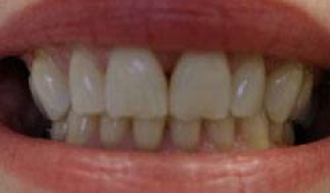 Dull teeth