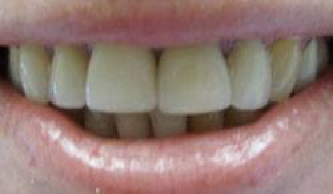 Yellowed teeth