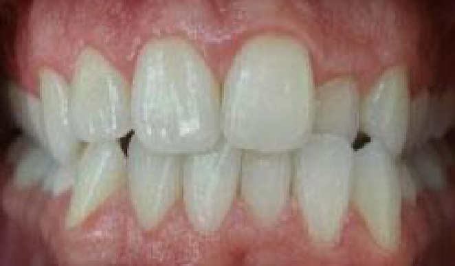 Misaligned teeth