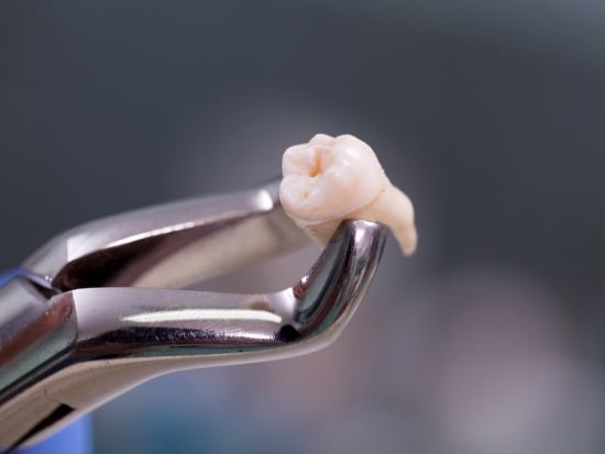 Forceps holding tooth after tooth extraction in El Reno