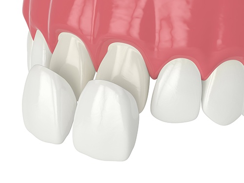 Illustration of veneers placed on front teeth 