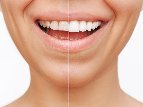 Woman before and after getting veneers 