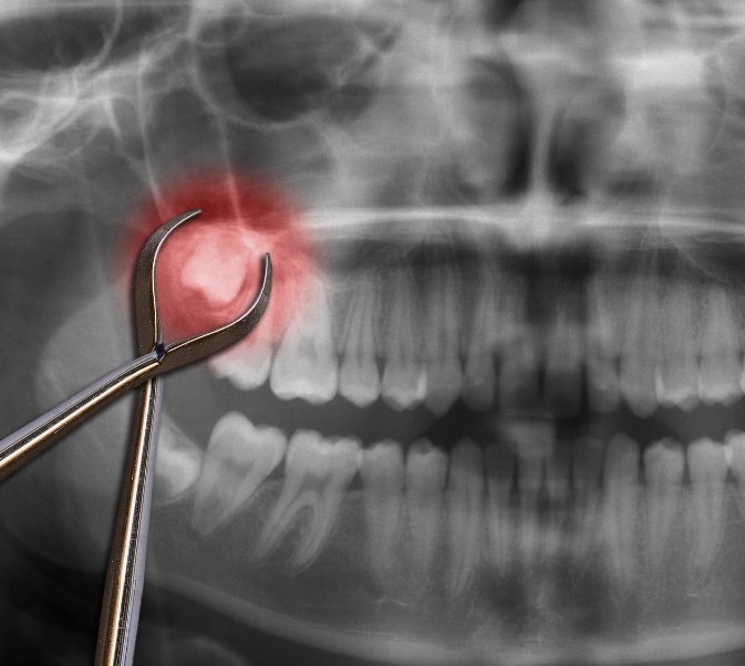 X ray and forceps illustrating wisdom tooth extractions in El Reno