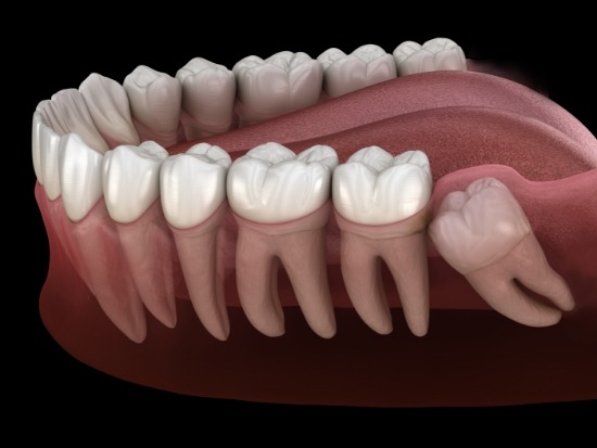 Illustration of an impacted wisdom tooth